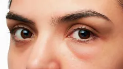 Hoe kom je van een gezwollen gezicht in de ochtend af en waarom gebeurt dit? Een stylist geeft antwoord.